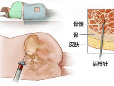 腰椎滑脫有哪些日常注意事項