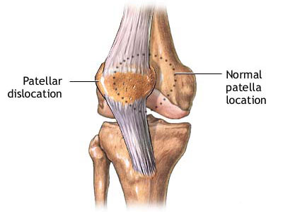 如何預防膝關節骨質增生