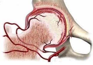 股骨頭壞死在早期怎麼診斷