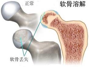 治療股骨頭壞死的注意事項