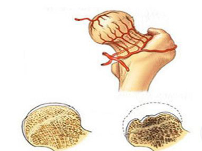 生活中怎麼預防股骨頭壞死