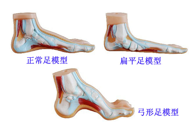 怎麼正確應對扁平足