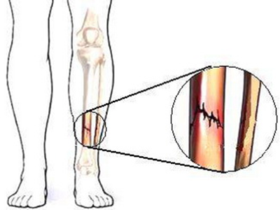 骨折不治療小心長成“長短腿”