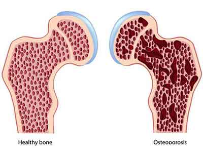 如何有效的預防骨質疏松症