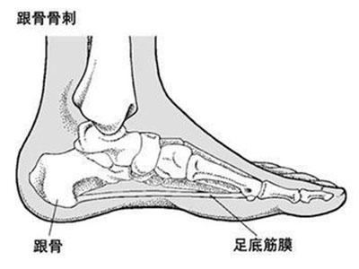 常穿硬底鞋 易使足底筋膜發炎、破裂