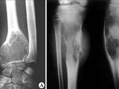 外傷性肢體持續疼痛腫塊跛行 可要警惕骨肉瘤