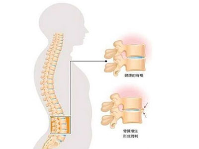 骨壞死一般在什麼位置發生