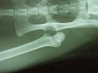 骨盆骨折患者易殘疾 骨盆骨折並發症有哪些