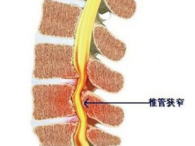 專家教你這五招預防頸椎管狹窄