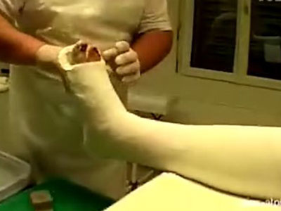 如何護理打石膏的骨折病人