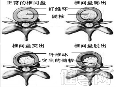 怎樣進行急性腰扭傷的家庭救護