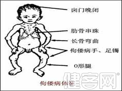 預防小兒佝偻病的方法