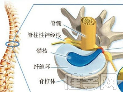 腰椎間盤突出治療有講究