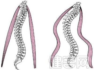 脊柱側彎不能怪小孩坐姿不正