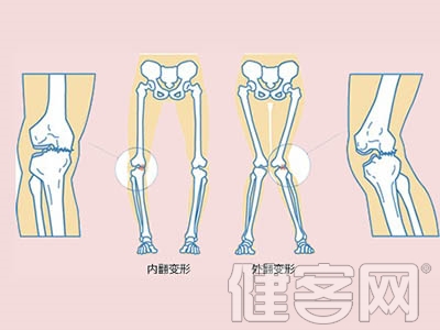 佝偻病可用按摩法改善