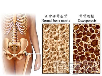 女性如何讓膝骨關節更健康