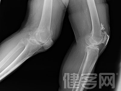 預防“空調腿” 注意膝關節保暖