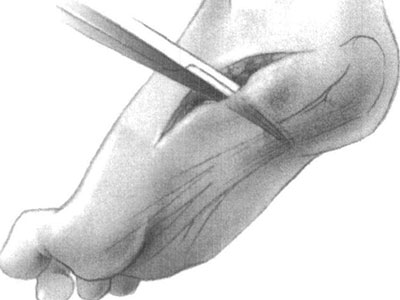 高弓足的手術方法