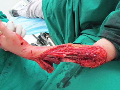 慶大霉素塗層胫骨髓內釘治療IIIC型開放性骨折