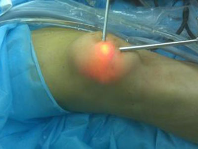 膝關節鏡技術——微創手術的佼佼者