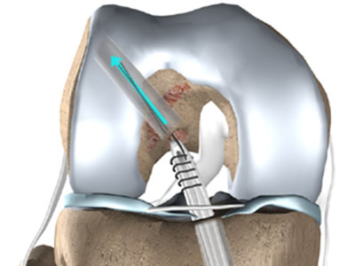 關節鏡手術在骨科的應用