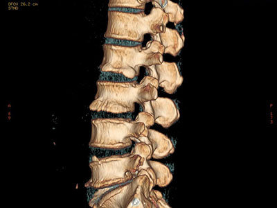 腰椎滑脫術中注意事項有哪些呢？