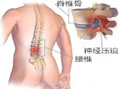 腰椎間盤突出的治療方法有哪些?