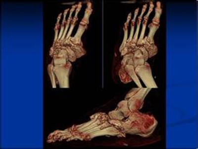 三維CT重建在骨關節損傷中的應用