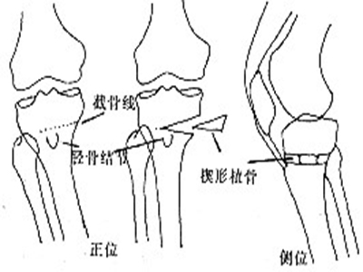 膝關節穿刺方法介紹