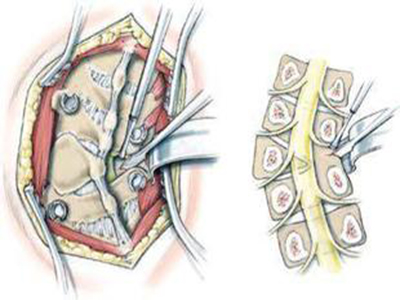 先天性脊柱側凸常用的手術方法