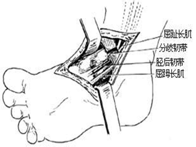 肢體延長術、骨轉移與肢體畸形矯正術