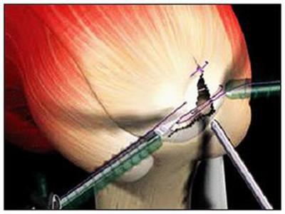 肩周炎的治療可選擇關節鏡微創手術