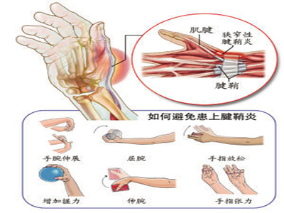 推割刀微創松解治療指屈肌腱狹窄性腱鞘炎