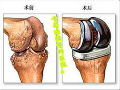 類風濕關節炎、滑膜炎的外科治療