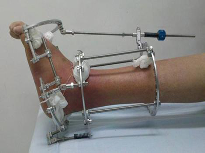 足下垂和足部畸形的手術治療