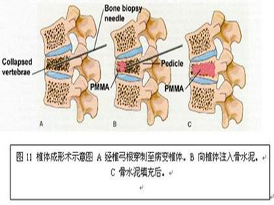 老年人脊椎骨折的福音——微創經皮椎體成形術