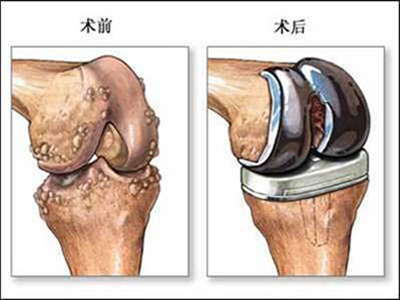 人工全膝關節置換手術