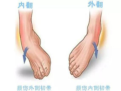 踝關節扭傷後頑固性疼痛和不穩定的手術治療