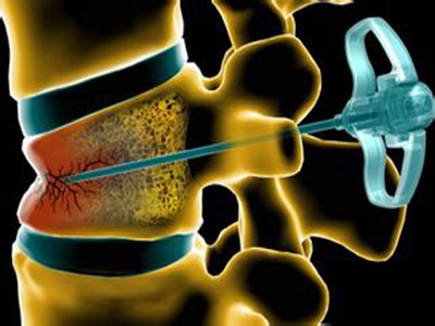 用“骨水泥”強化椎體治療脊柱骨質疏松性壓縮骨折