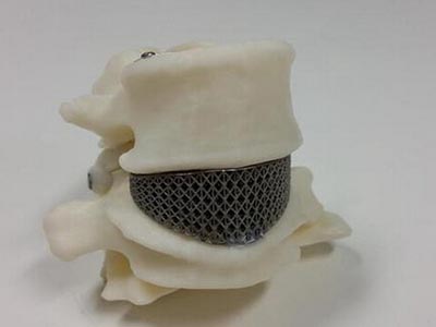 澳大利亞完成首例3D打印钛金屬脊柱植入手術
