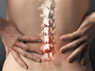 腰椎間盤突出治療的最新方法