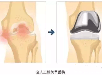 膝關節骨關節炎常見手術