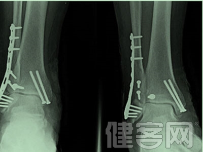 三踝骨折中鋼板固定後踝優於螺釘