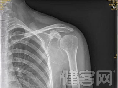 華南地區首例“肩胛骨3D打印钛合金假體植入術”