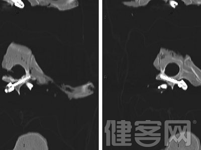 經椎板螺釘用於胸椎固定安全性較好