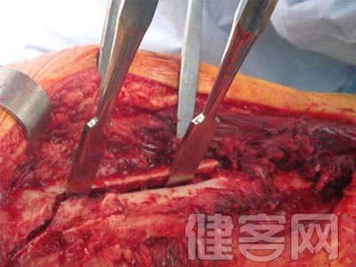 手術技巧：保留關節囊的股骨假體周圍 B 型骨折翻修
