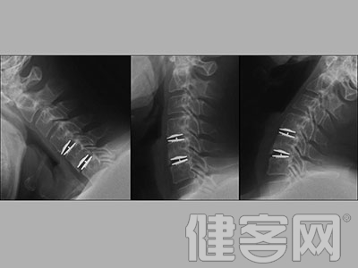 脊柱非融合術後異位骨化呈漸進性