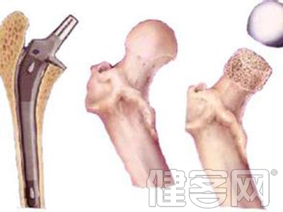 股骨頸螺釘手術技巧：進釘點瞄准小轉子上緣