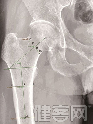 股骨頸螺釘手術技巧：進釘點瞄准小轉子上緣