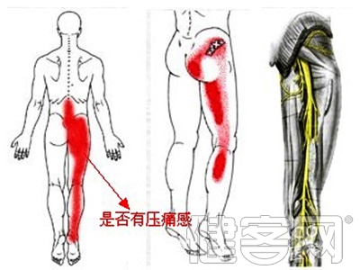 坐骨神經痛的介紹與用藥治療